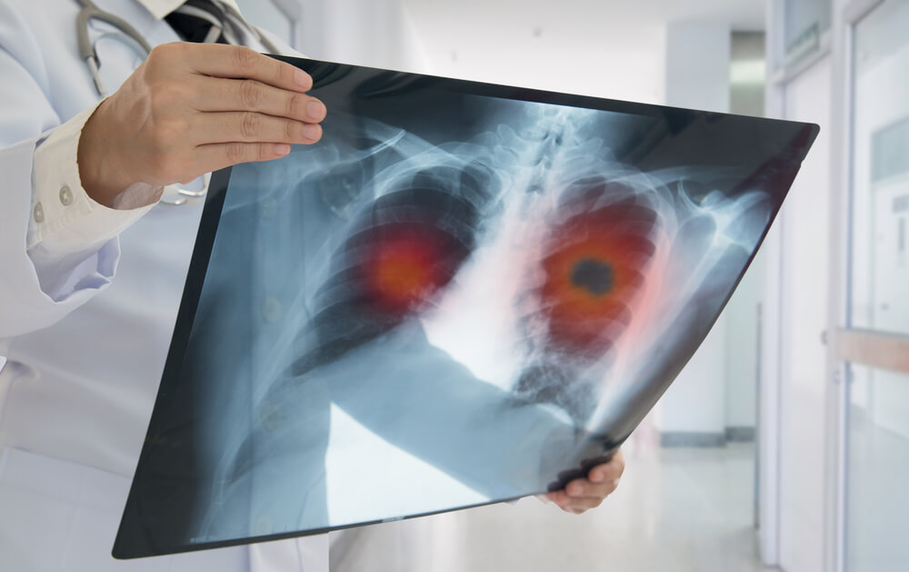MRI Rehberli Kriyoablasyonla Kesiksiz Kanser Tedavisi!